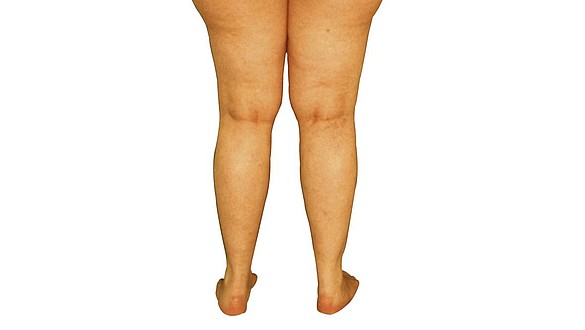 Qual é o custo do tratamento com veias a laser